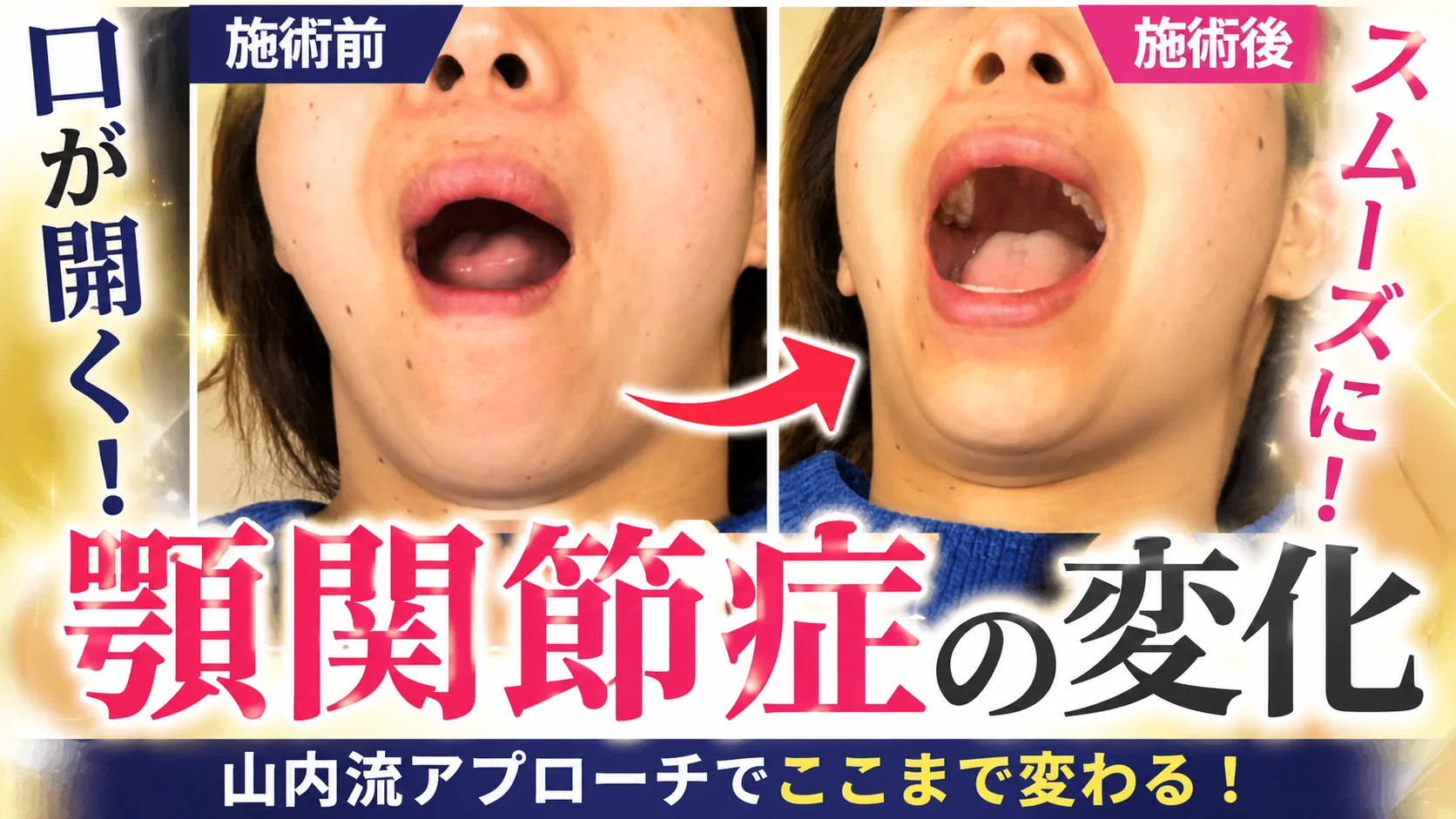 顎関節の動きが楽になった様子